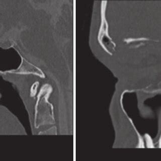 Admission Noncontrast Head Computed Tomography Scan Demonstrating