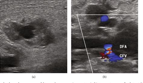 Figure From Viabahn Stent Graft Implantation For Iatrogenic