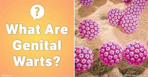 Stages Of Genital Warts