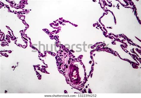 Histopathology Lung Emphysema Light Micrograph Photo Stock Photo