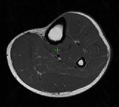 1: MRI Data of Calf Muscles (courtesy [Essafi et al. 2009a ...