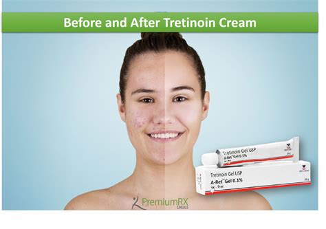 Before and After Tretinoin Cream | PremiumRx- Online Pharmacy