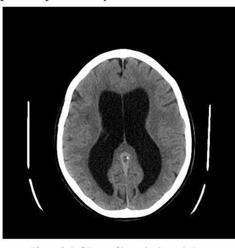 Measurement of Normal Brain Lateral Ventricles byUsing CT | Semantic ...