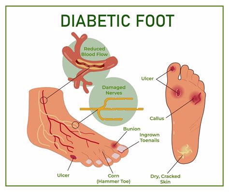 Arterial Ulcer On Foot Online | emergencydentistry.com