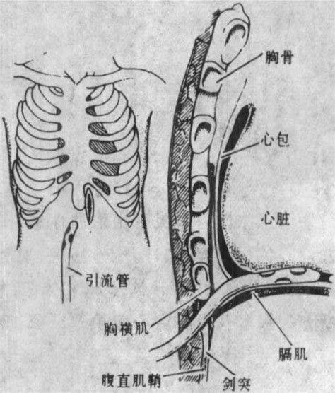 心包切开引流术 心脏外科手术 医学