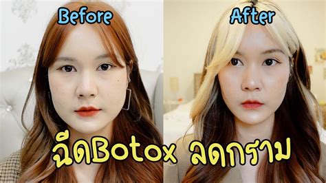 รีวิวฉีดbotoxลดกราม หน้าเรียว งบประหยัด ว้าวซ่ามาก This Is Pear สรุปข้อมูลที่เกี่ยวข้อง