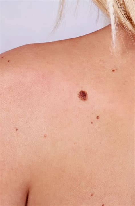 Skin Cancer Reconstructive Surgery The Day Clinic