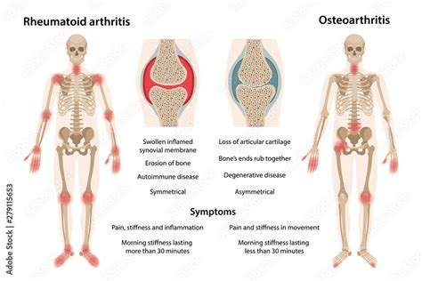 MobileThe Difference Between Rheumatoid Arthritis And Osteoarthritis