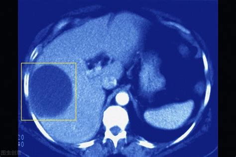 肝囊腫需要治療嗎？如何治療？醫生詳細告訴您答案 每日頭條