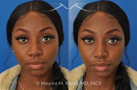 New York Facial Plastic Surgery Liquid Rhinoplasty Before And After