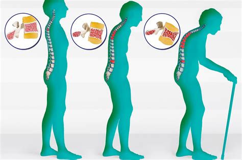 Osteoporosi E Le Fratture Vertebrali Gestione E Interventi Di