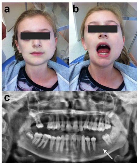 Chronic Osteomyelitis Of The Jaw Pivotal Role Of Microbiological