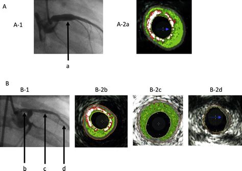 Virtual Histology Intravascular Ultrasound Evaluation Of Coronary