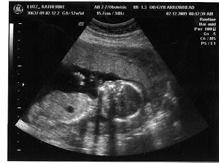 new: Our 18 week Ultrasound Pictures