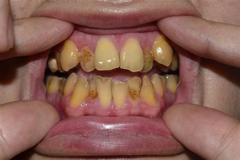 What Causes Yellow Teeth Tips For Brighter Smiles Fitzgerald Dentistry