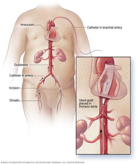 Thoracic aortic aneurysm Disease Reference Guide - Drugs.com