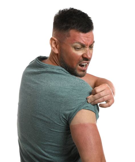 Man With Sunburned Skin On White Background Stock Image Image Of