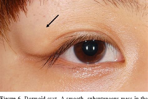 Figure 1 From Clinical Characteristics Of Benign Eyelid Tumors Semantic Scholar