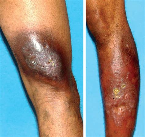 Scielo Brasil Granulomatous Slack Skin A Rare Subtype Of Mycosis