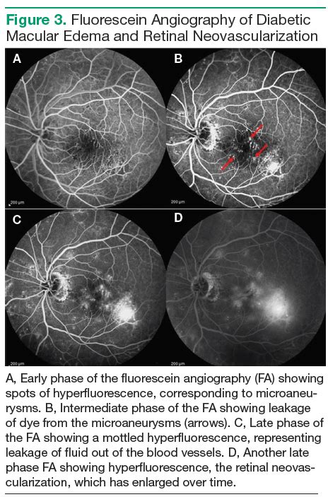 Diabetic Macular Edema Fluorescein Angiography