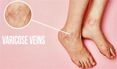 Varicose Veins Symptoms Causes And Treatment