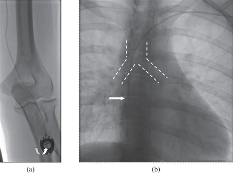 Totally Implantable Venous Power Ports Of The Forearm And The Chest Initial Clinical Experience