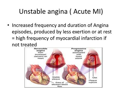 Ppt Ischemic Heart Diseases Ihd Powerpoint Presentation Free