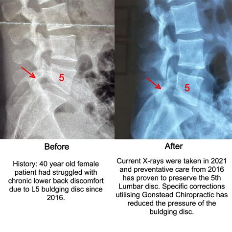 Preventative Care Of Disc Degeneration A Chiropractic Clinic Utilizes Gonstead Method