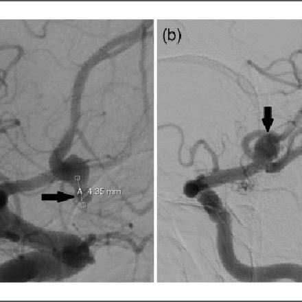 Dsa With Right Carotid Injection A Showing Remnant Of Partially