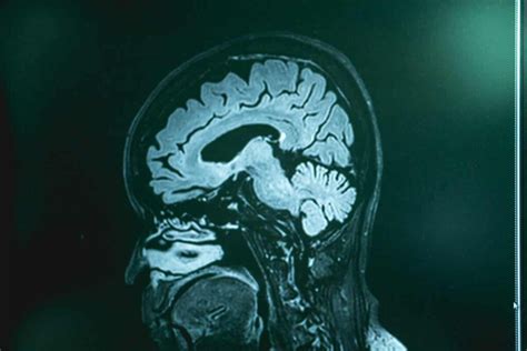 Naegleria Fowleri Infection: The Brain-eating Amoeba - Step To Health