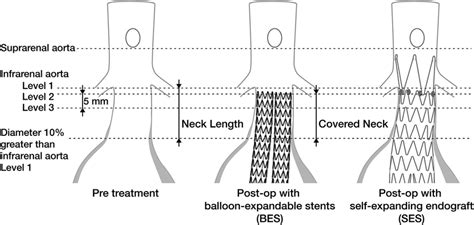 Location Of Aortic Diameter Measurements On Preimplant And