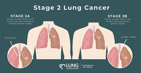 Stage II Lung Cancer | Prognosis, Survival Rates & Treatment