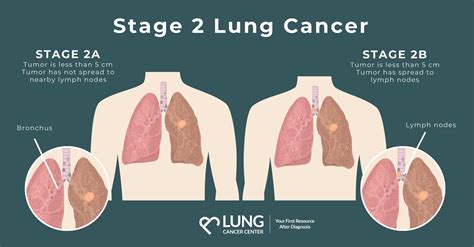 Stage Ii Lung Cancer Prognosis Survival Rates And Treatment