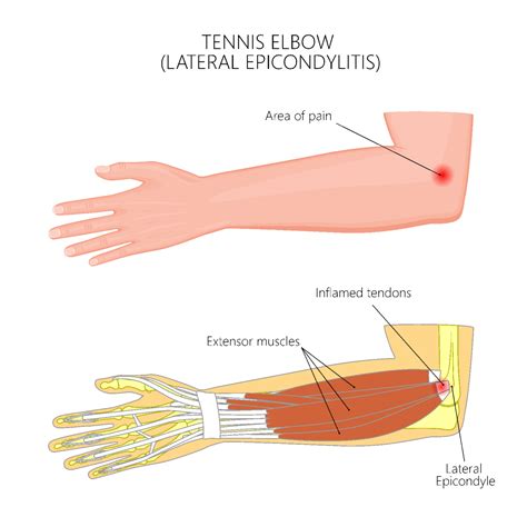 Tennis Elbow Injection