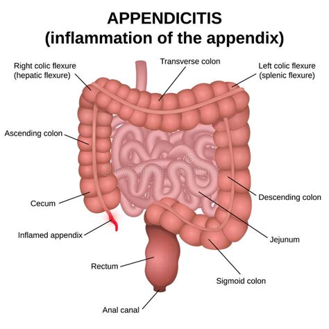 Inflammation Of The Appendix Stock Vector Illustration Of Organ Guts