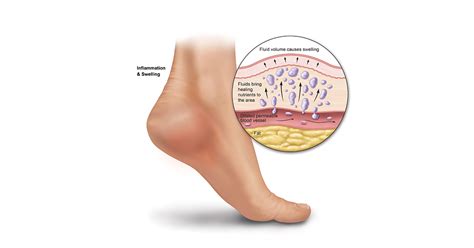 Swelling Foot Pain On Side Online Emergencydentistry