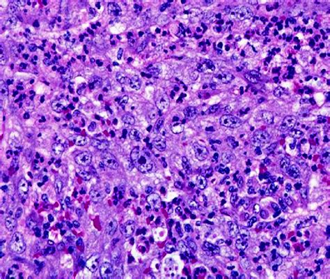 Histopathological Examination Shows Tumor Contained Spindle Cells And