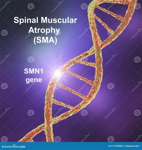 Spinal Muscular Atrophy Sma A Genetic Neuromuscular Disorder Stock