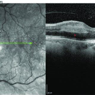 Heidelberg Sd Oct Macular Scan Of Multiple Patches Of Inner Nuclear And