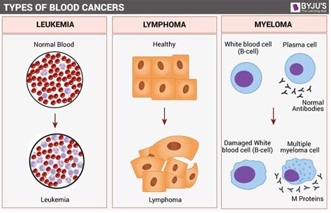 Leukemia Symptoms Signs Causes Types Treatment 55 Off