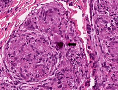 Pathology Outlines Sarcoidosis