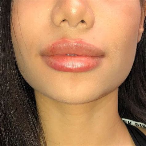 Pin On Lip Fillers