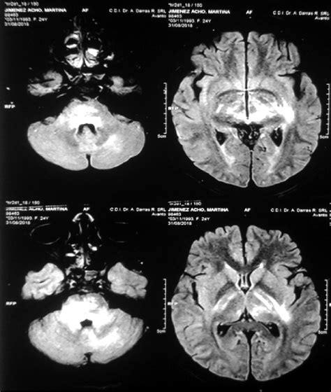 secuencia Flair áreas de leucoencefalopatia en tronco y núcleos de la