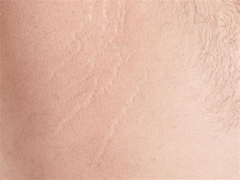 Belly Stretch Marks Nude Royalty Free Images Stock Photos Pictures Shutterstock