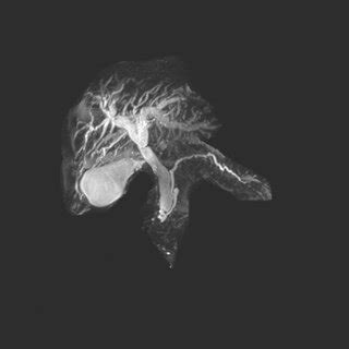 MRI Demonstrating Moderate To Severe Dilation Of The Intrahepatic Ducts