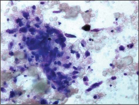 Figure From Aspiration Biopsy Cytology Of Tumoral Calcinosis