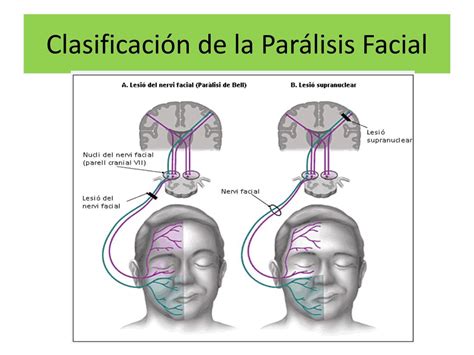 PPT PARÁLISIS FACIAL PERIFÉRICA PowerPoint Presentation free