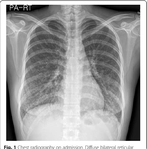 Bronchiolitis Obliterans Organizing Pneumonia Pulmonary Medicine Hot Sex Picture