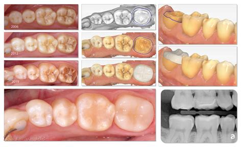 Amelogenesis Imperfecta Progression And Digital Solution Digital Enamel