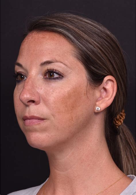 Dermal Fillers Case 18916